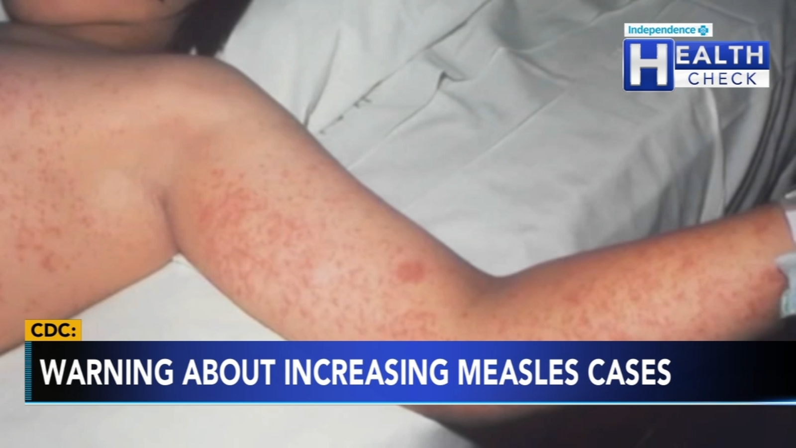 2025 Measles Outbreak: Virginia Confirms Second Case 2025 Measles Outbreak: Virginia Confirms Second Case