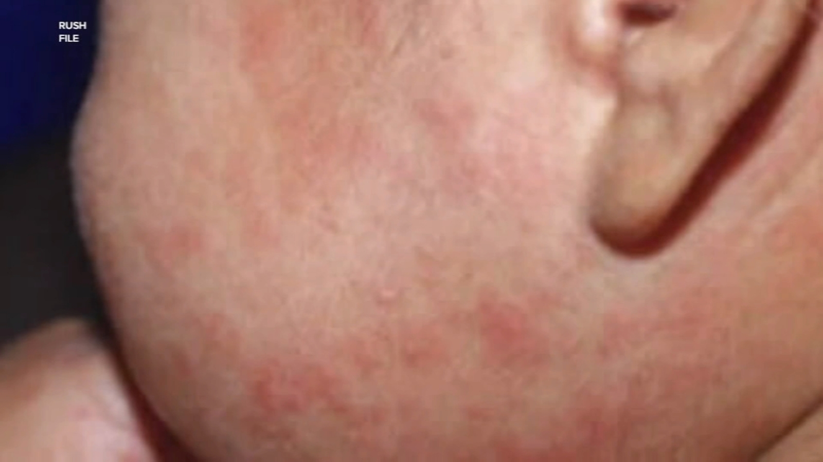 Another Measles Case In Virginia: Total Reaches Two In 2025 Another Measles Case In Virginia: Total Reaches Two In 2025