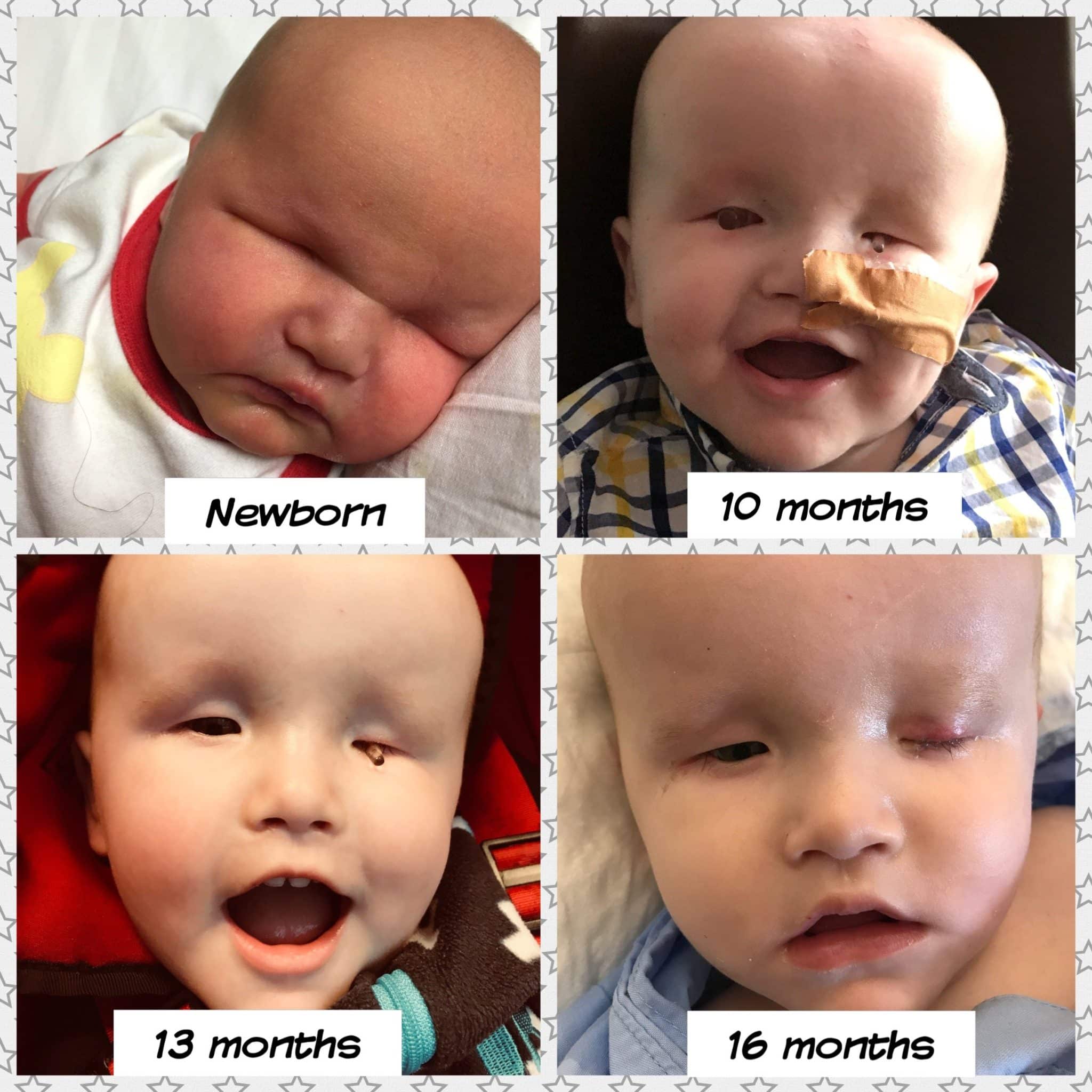 Bilateral Anophthalmia: Understanding The Rare Condition Of Babies Born Without Eyes Bilateral Anophthalmia: Understanding The Rare Condition Of Babies Born Without Eyes