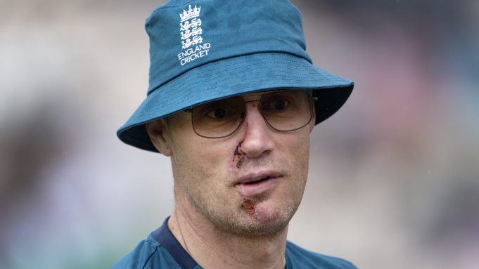 Freddie Flintoff's Face After Top Gear Crash: An Update Freddie Flintoff's Face After Top Gear Crash: An Update
