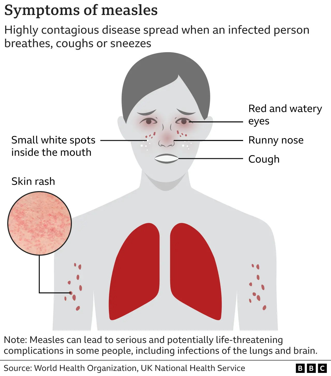 Measles Cases In Kansas Increase By Six: What You Need To Know Measles Cases In Kansas Increase By Six: What You Need To Know