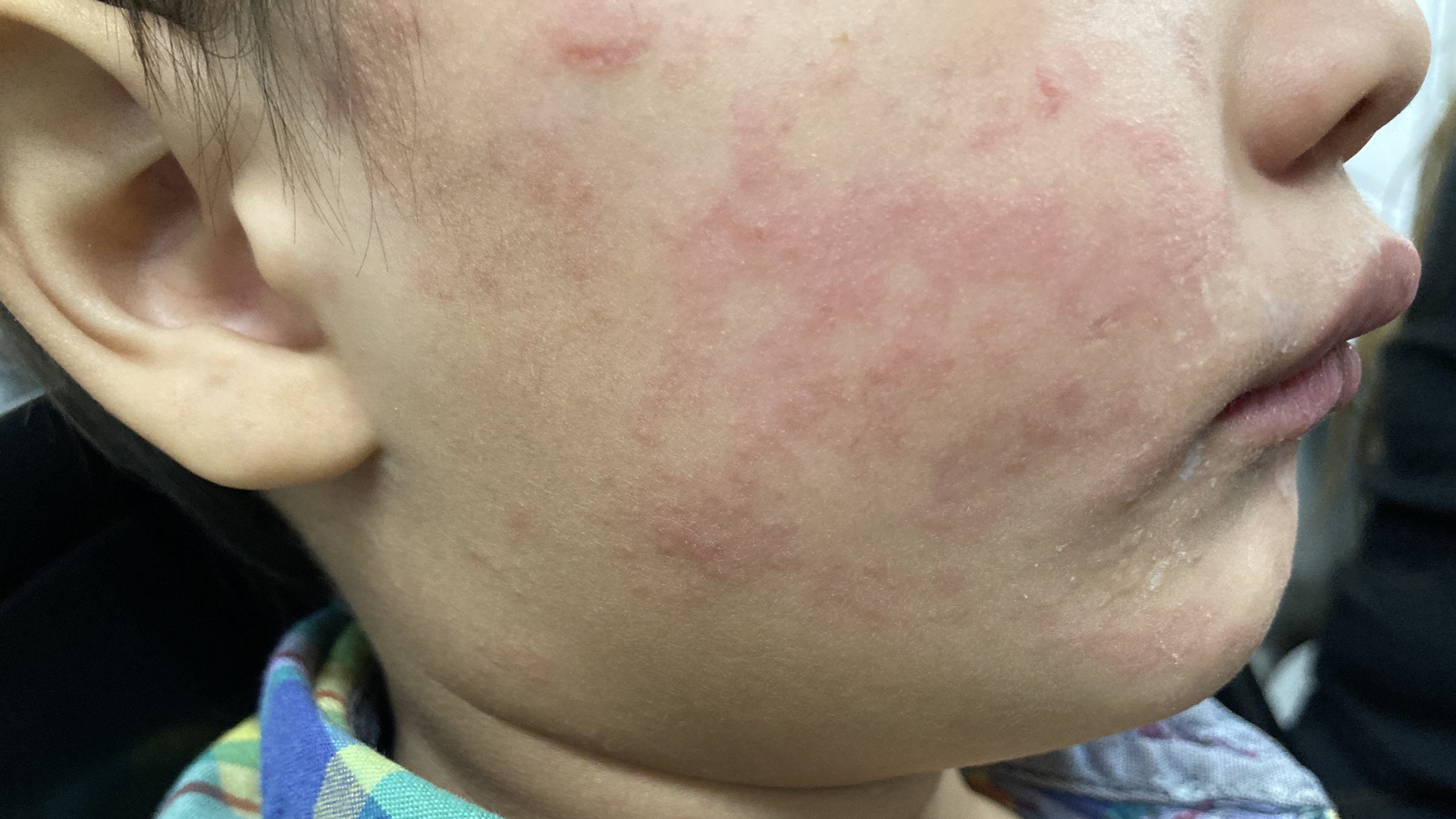 Measles Cases In The US Rise Slightly To 1,046: Indiana Outbreak Concludes Measles Cases In The US Rise Slightly To 1,046: Indiana Outbreak Concludes