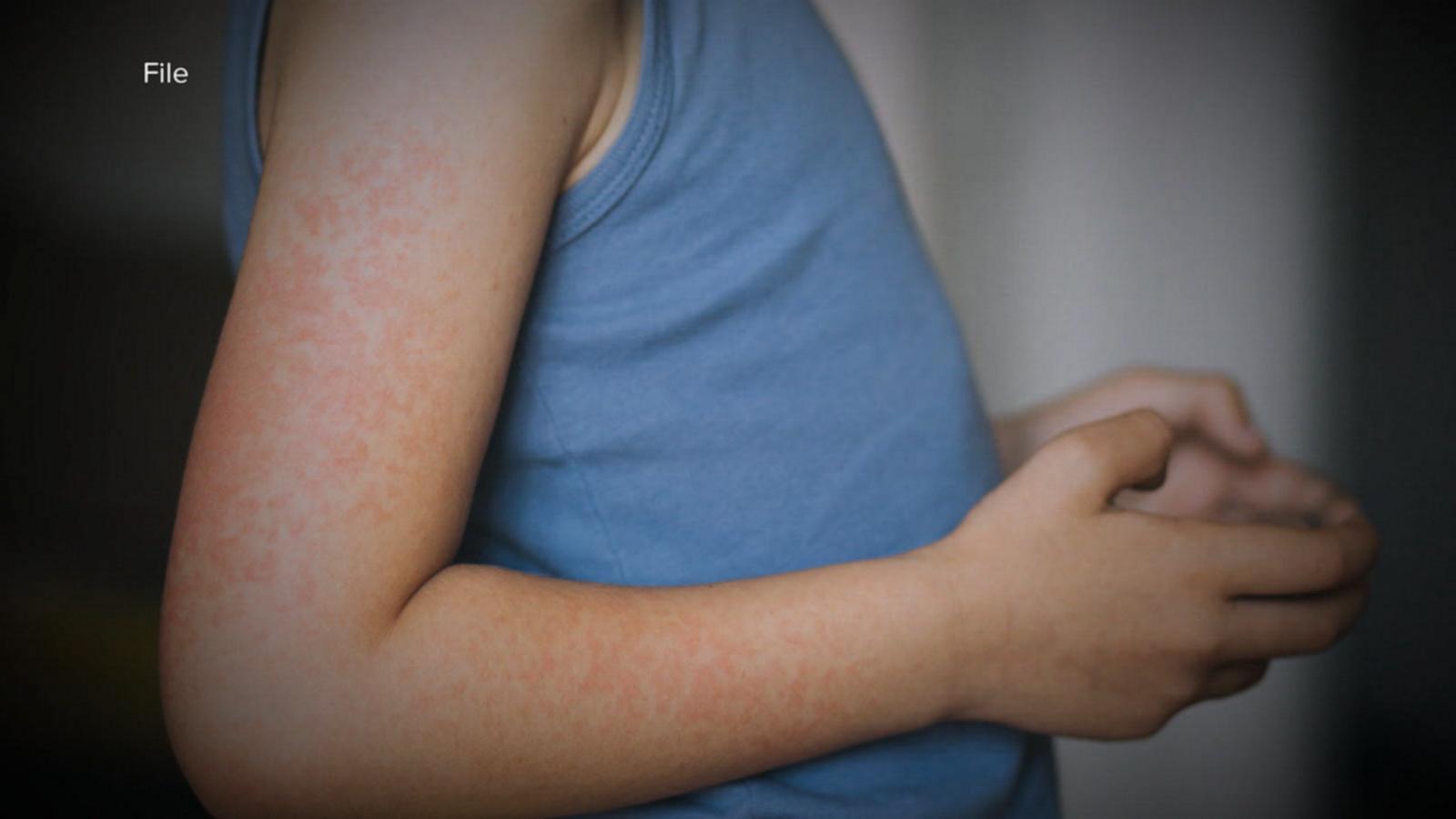 Rising Measles Cases In Texas: Understanding The Separate Clusters Rising Measles Cases In Texas: Understanding The Separate Clusters