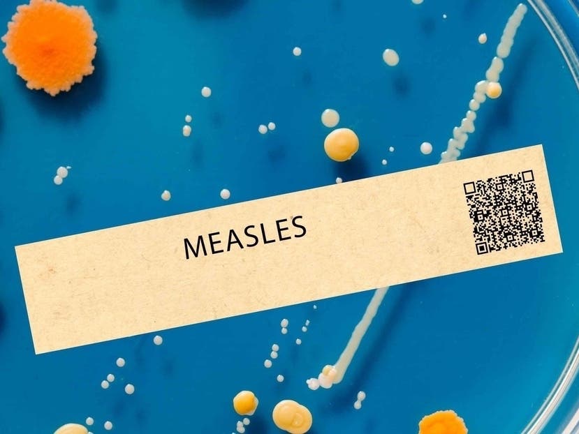 Second Measles Case Confirmed In Virginia In 2025: What We Know Second Measles Case Confirmed In Virginia In 2025: What We Know
