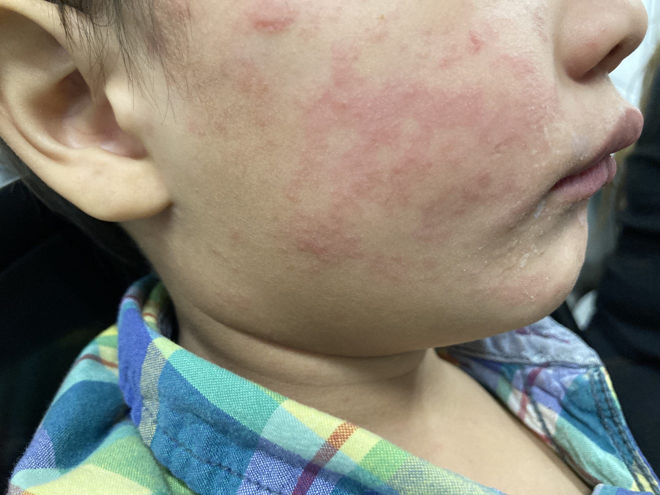 Update: Second Measles Case Confirmed In Virginia For 2025 Update: Second Measles Case Confirmed In Virginia For 2025